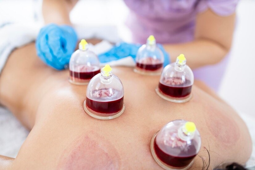 Wet Cupping Massage London