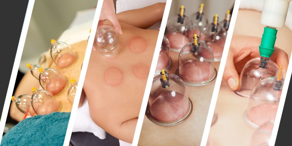 Dry Cupping Massage in London by Breathe Treatments